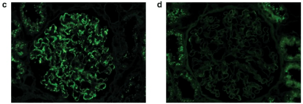 There is unmasked kappa (c), but not lambda (d), light chains in the same distribution as IgG on paraffin immunofluorescence. 