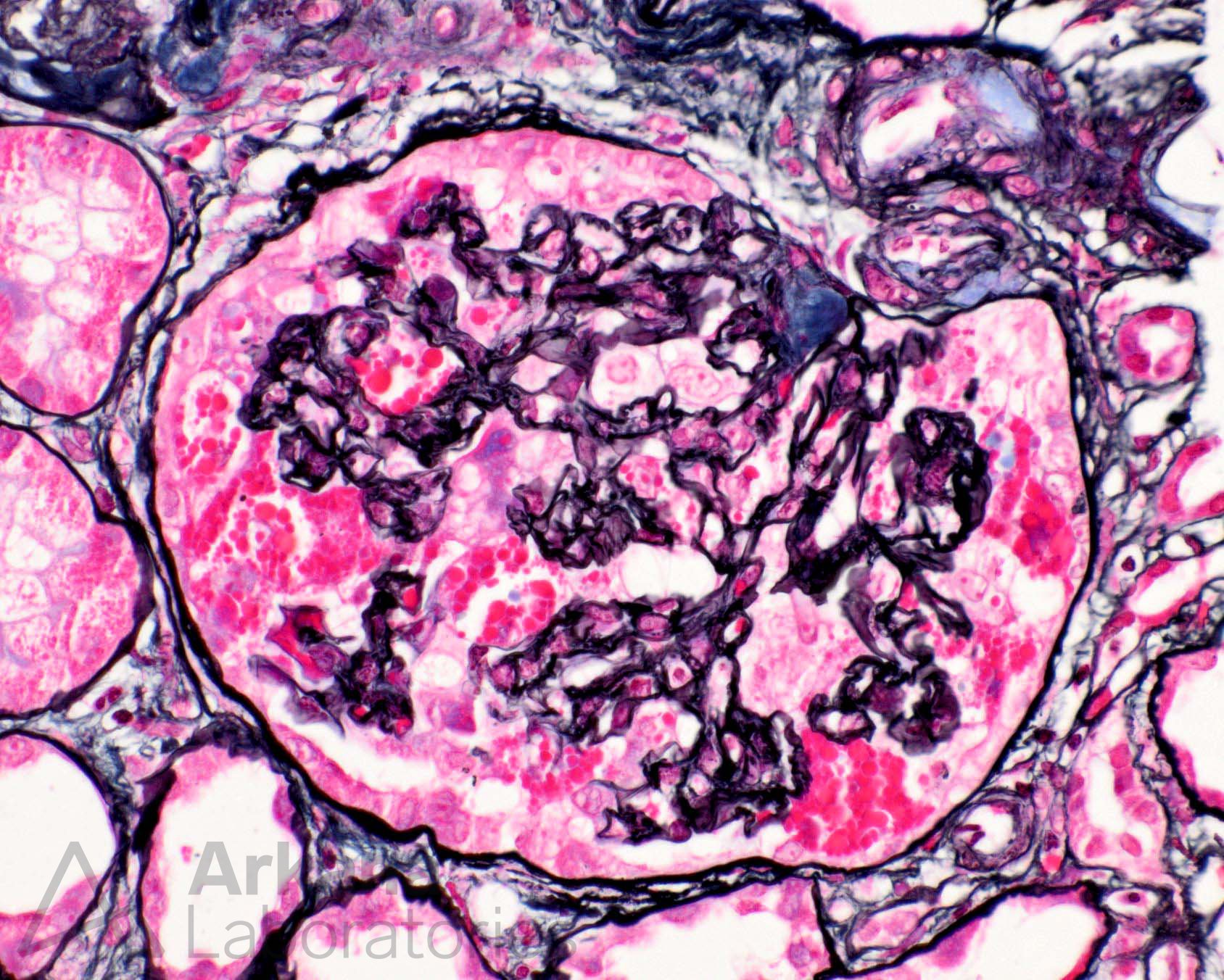 SARS-CoV-2, COVAN, Covid-19, collapsing Myoglobin cast, renal pathology