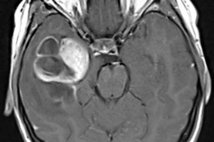 Ganglioglioma tumor MRI scan