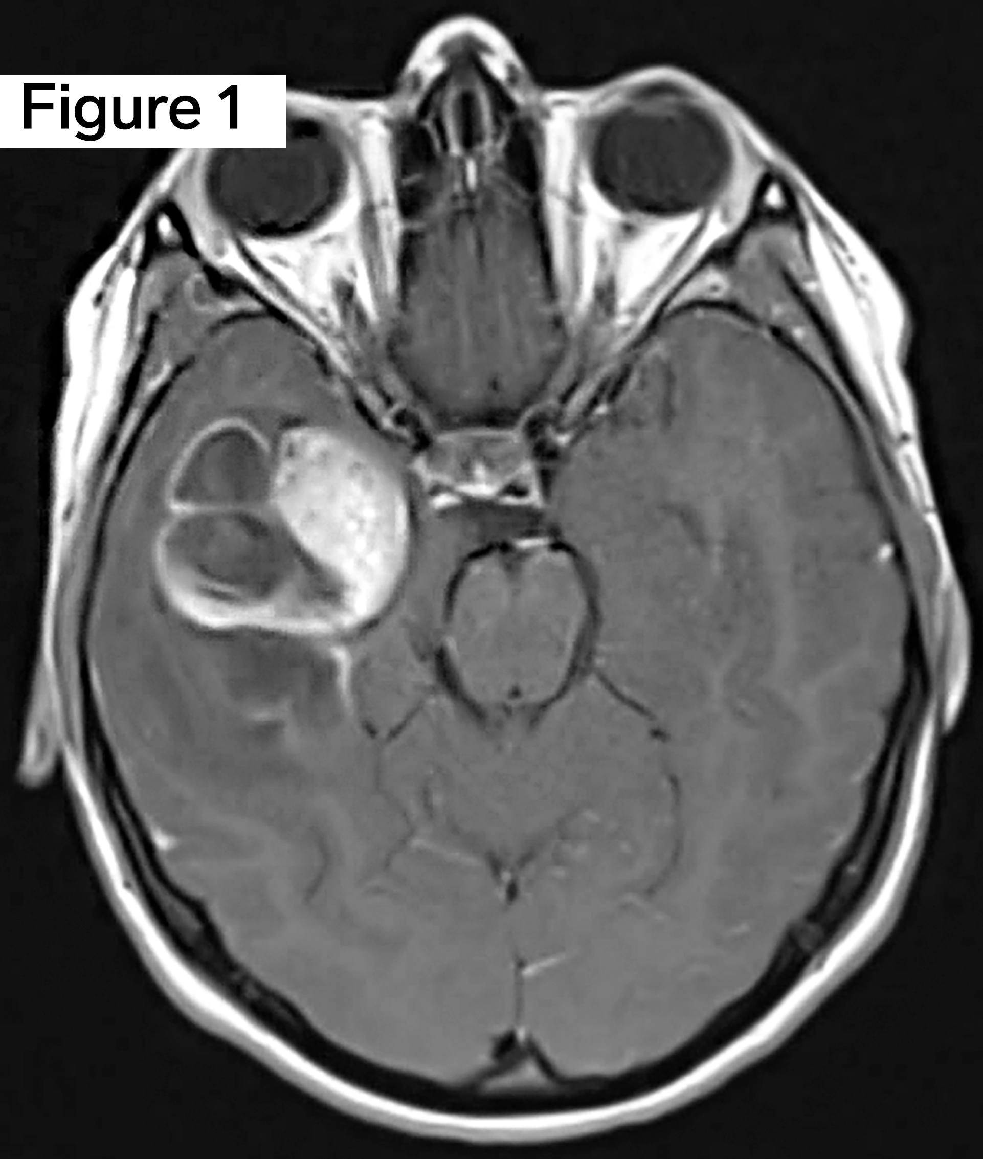 Ganglioglioma tumor MRI scan