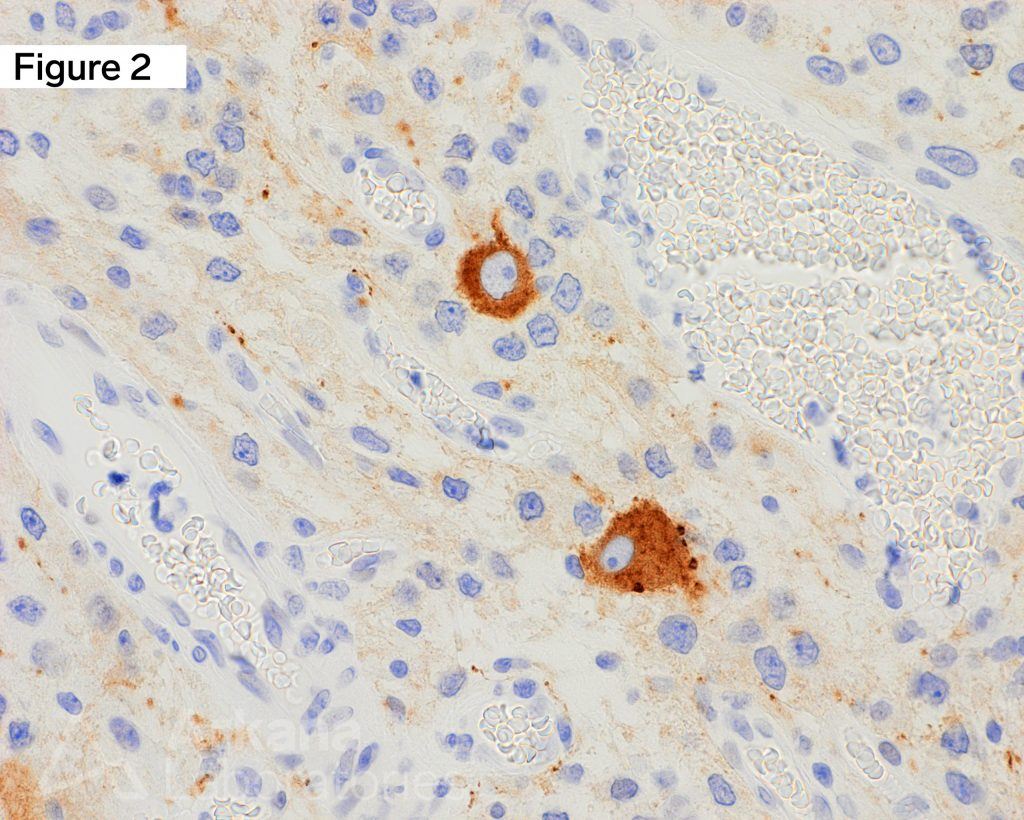 Ganglioglioma WHO Grade 1