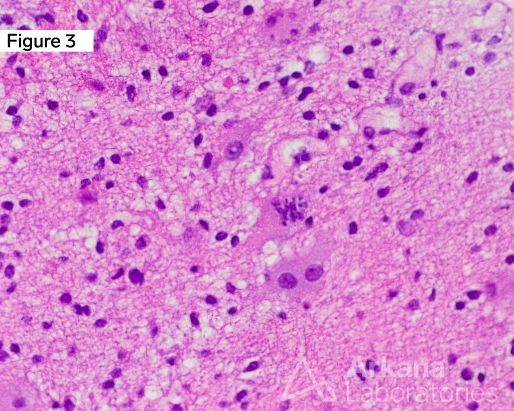 Ganglioglioma WHO Grade 1