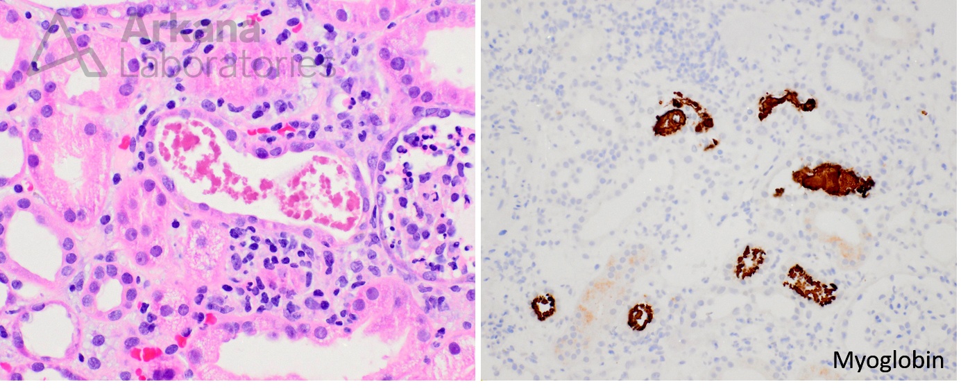 SARS-CoV-2, COVAN, Covid-19, collapsing Myoglobin cast, renal pathology