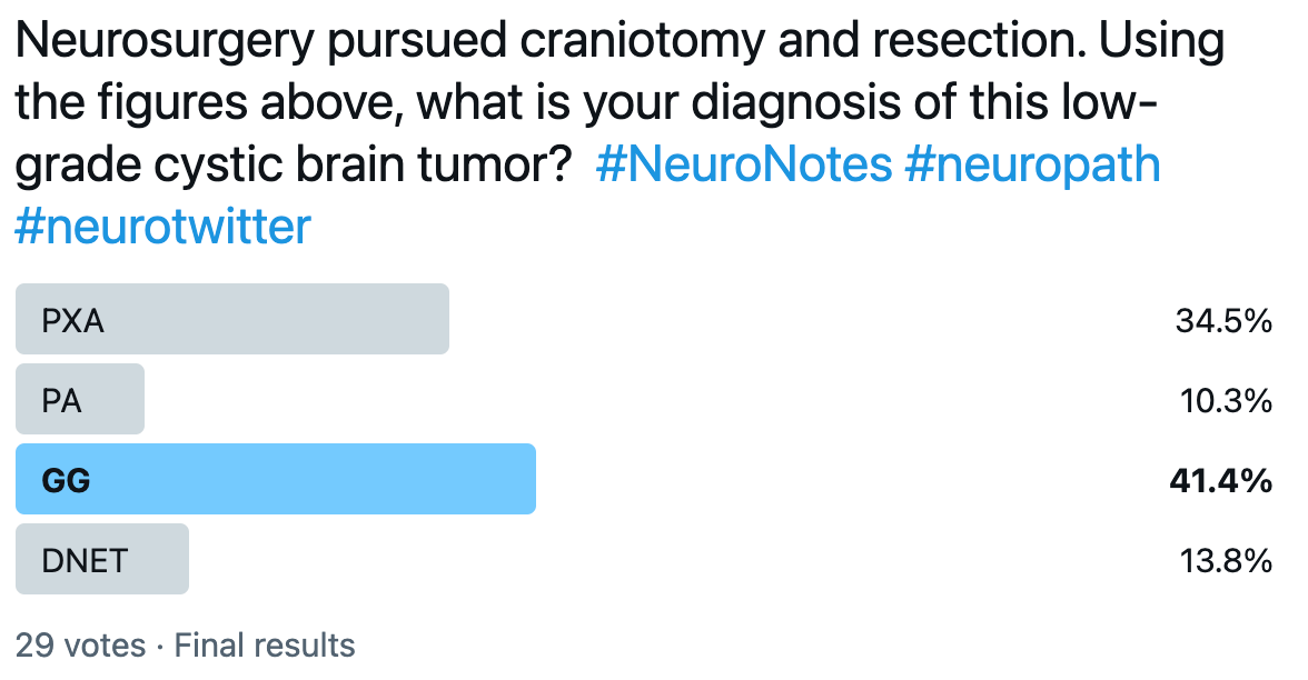 Neuro Notes Twitter Poll Ganglioglioma Answer