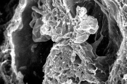 Distorted Glomerulus with Fibrocellular Crescent