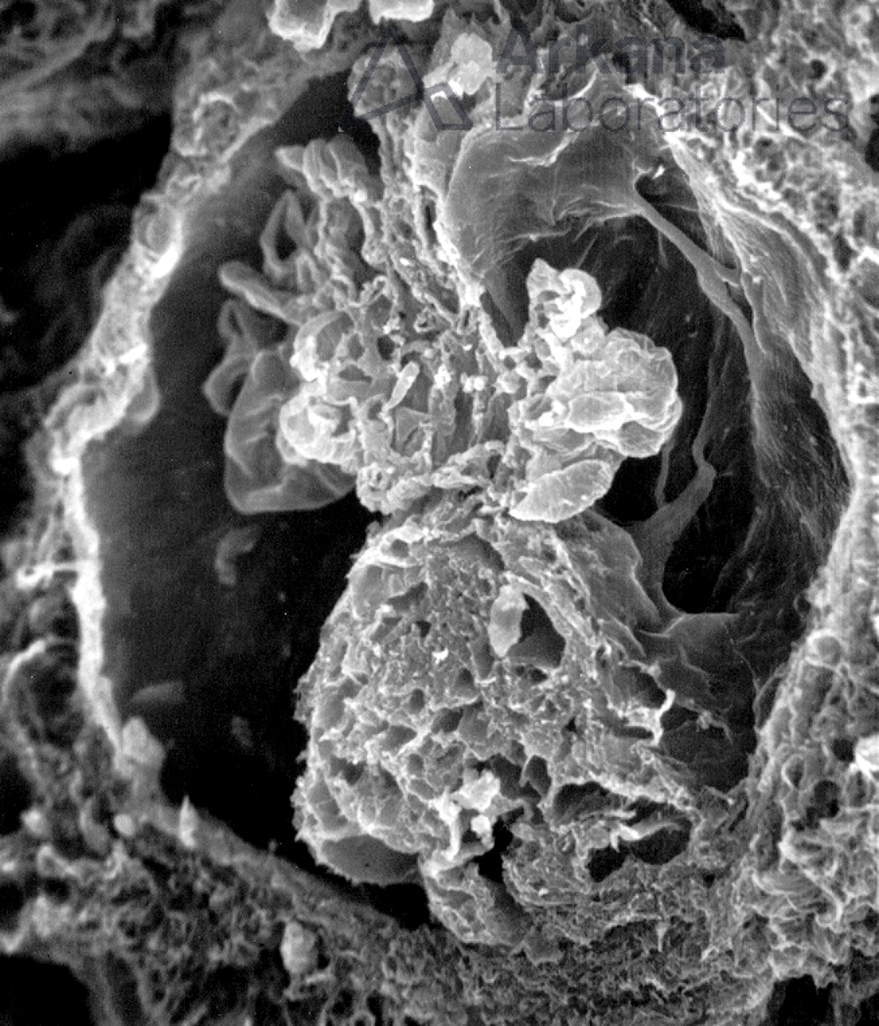 Distorted Glomerulus with Fibrocellular Crescent