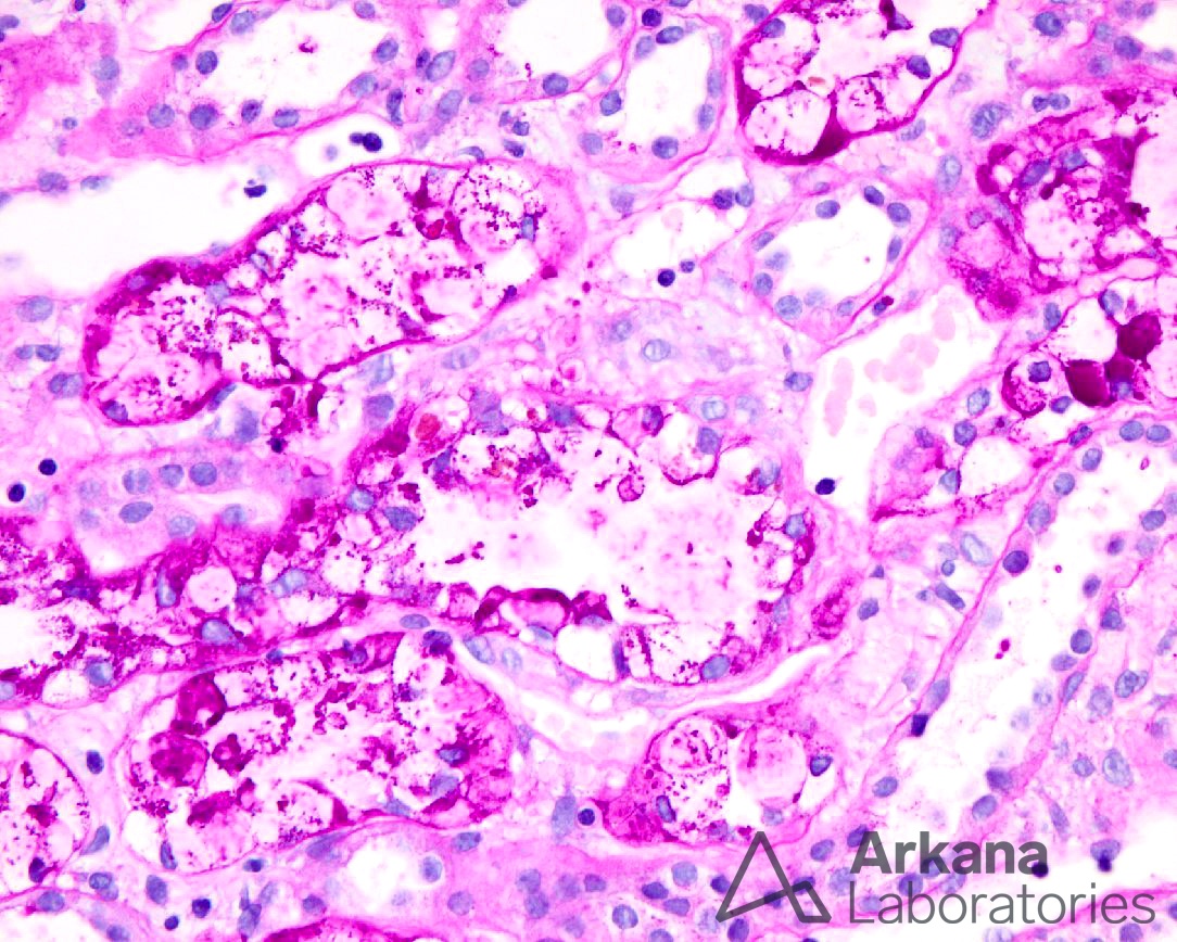 armanni-ebstein, diagnose this, arkana laboratories