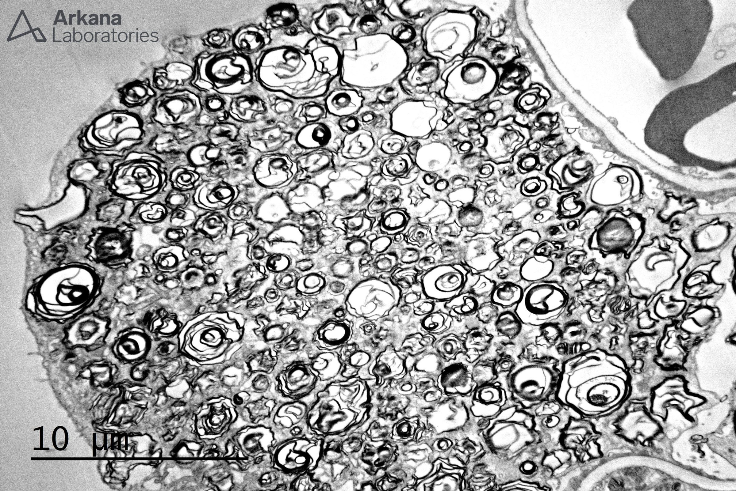 Fabry's disease, myelosomes, zebra bodies, X linked disease