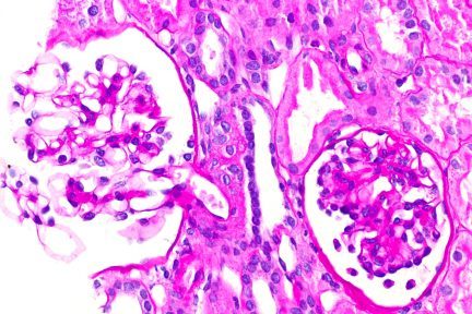 Pediatric Nephrotic Syndrome, childhood nephrotic syndrome, CSA, CNI, juxtaglomerular apparatus