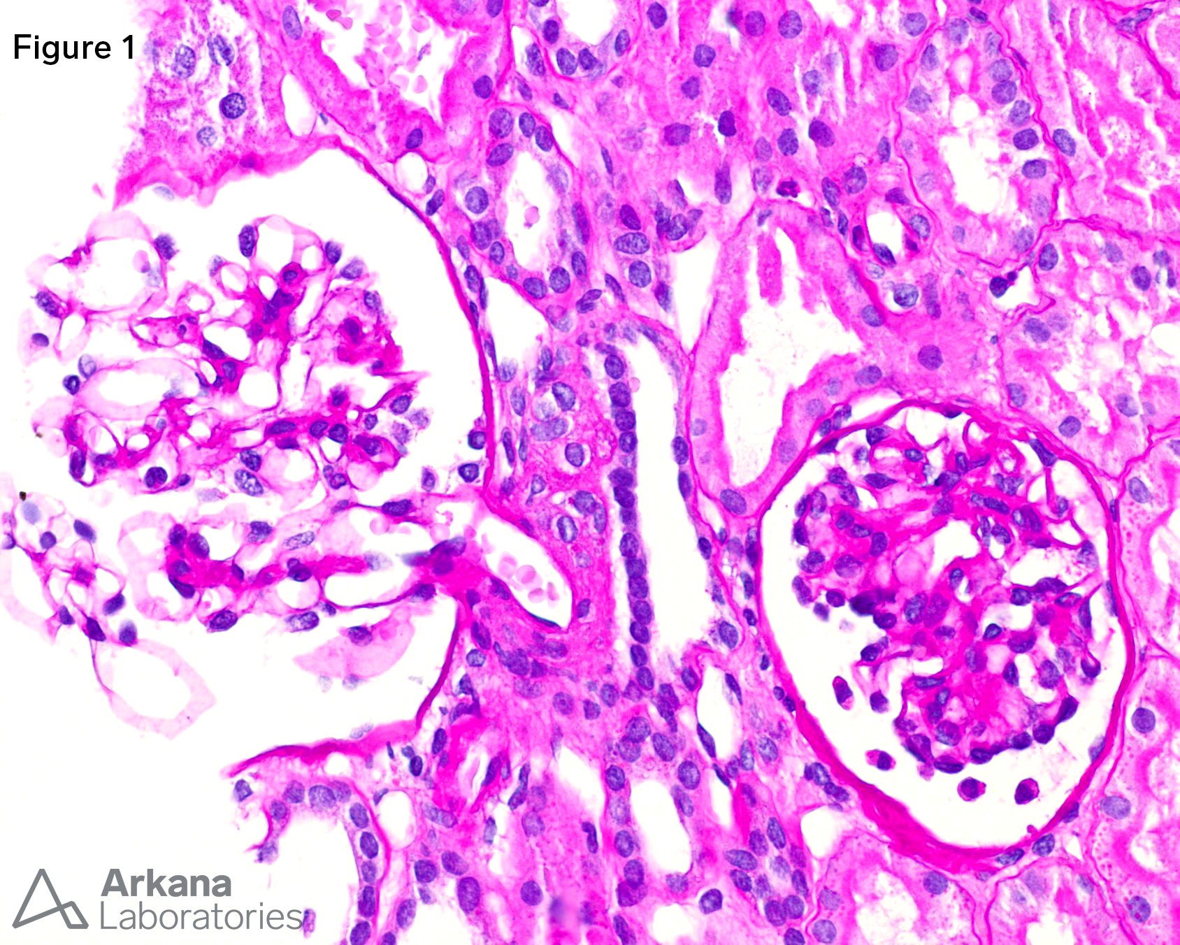 Pediatric Nephrotic Syndrome, childhood nephrotic syndrome, CSA, CNI, juxtaglomerular apparatus