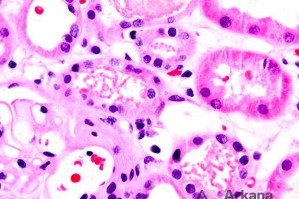 myoglobin cast, diagnose this