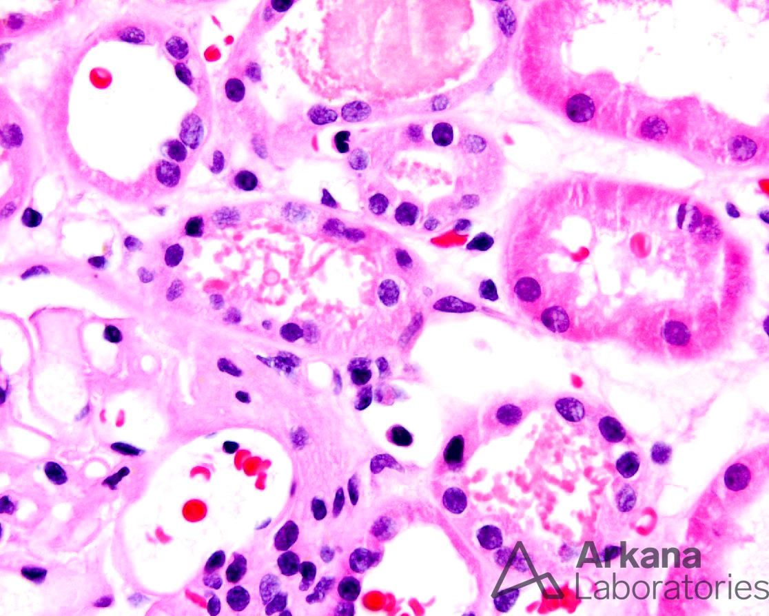 myoglobin cast, diagnose this