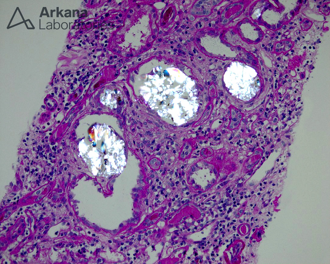 renal oxalosis, Diagnose This