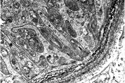 light chain deposition disease, Diagnose This, Arkana Laboratories, renal pathology