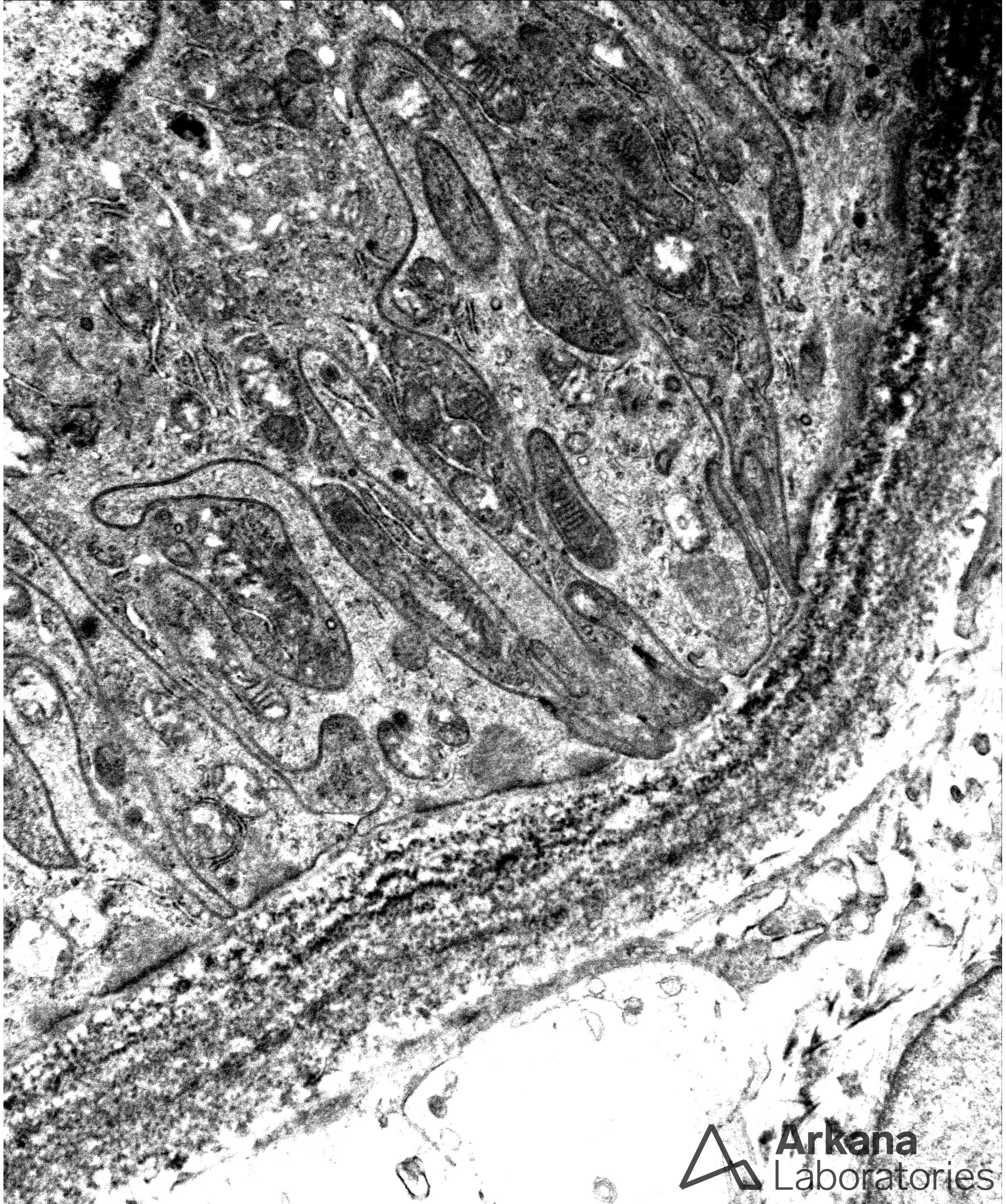 light chain deposition disease, Diagnose This, Arkana Laboratories, renal pathology