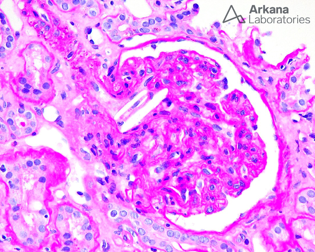 Renal atheroembolic disease, diagnose this!, Arkana Laboratories