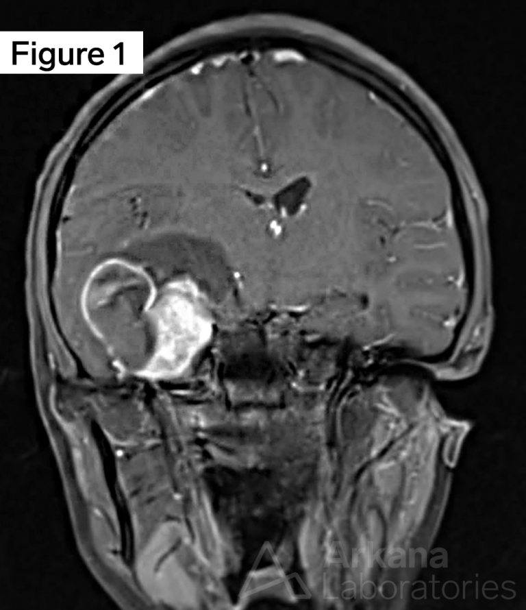 Ganglioglioma BRAF V600EMutated Neuro Notes Arkana Labs