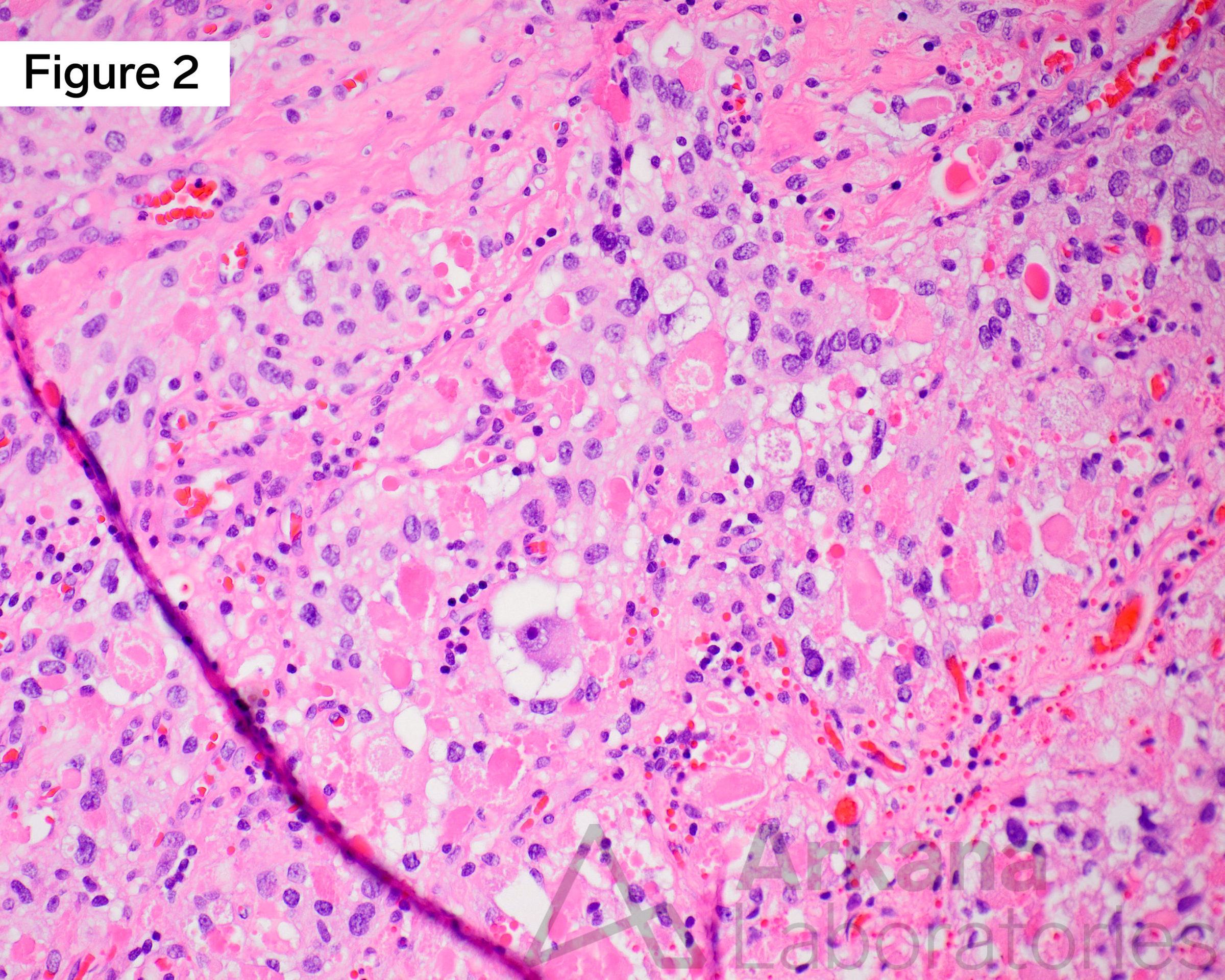 BRAF V600E, neuro stain, neuropathology