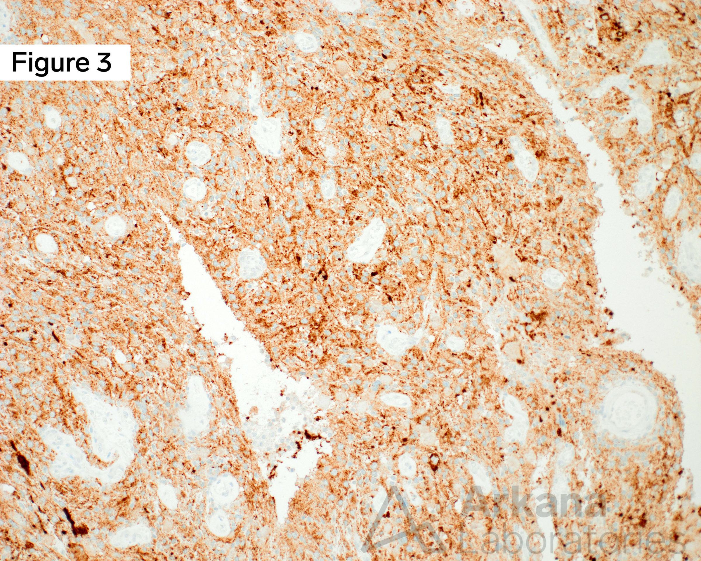 BRAF V600E, neuro stain, neuropathology