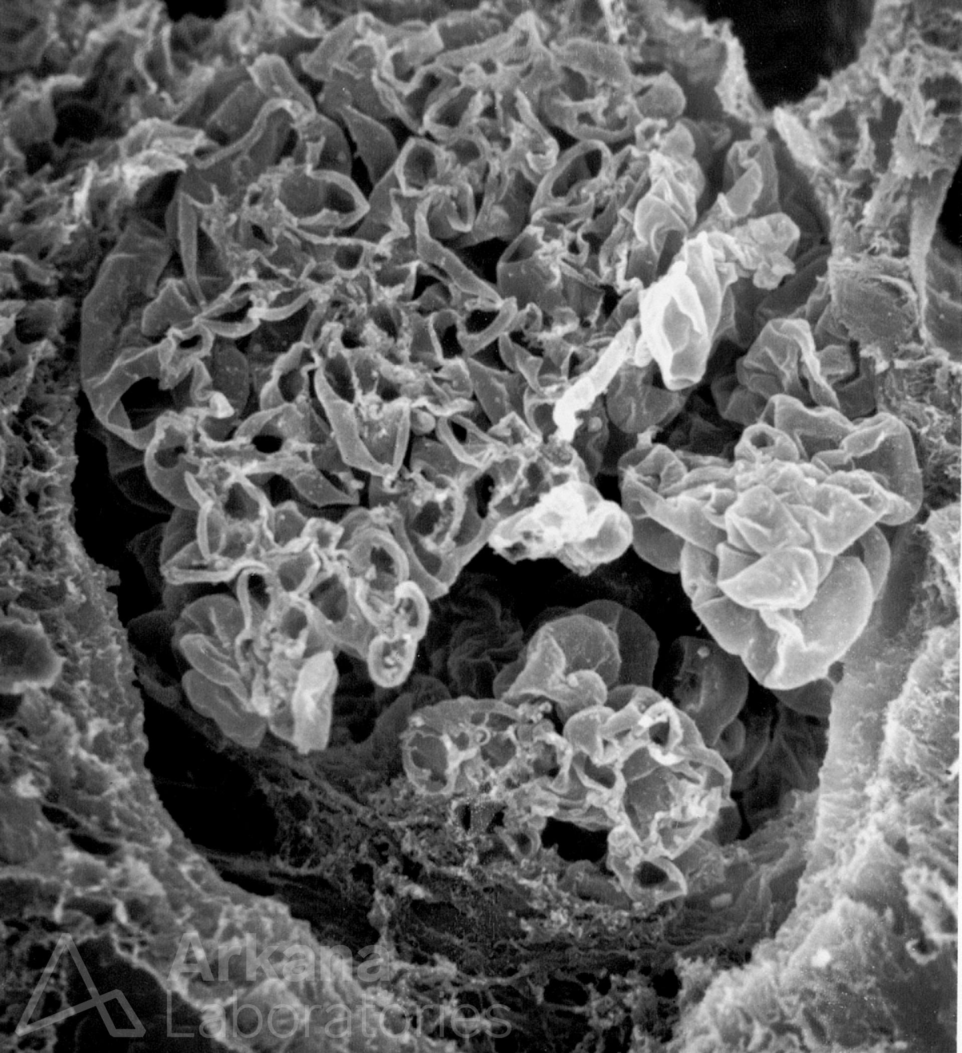 glomerulus showing a fibrocellular crescent