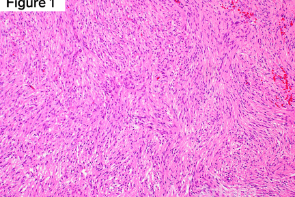 Hematoxylin and eosin (H&E)-stained sections with EMA+, SSTR2+, STAT6-
