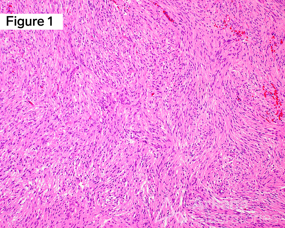 Hematoxylin and eosin (H&E)-stained sections with EMA+, SSTR2+, STAT6-
