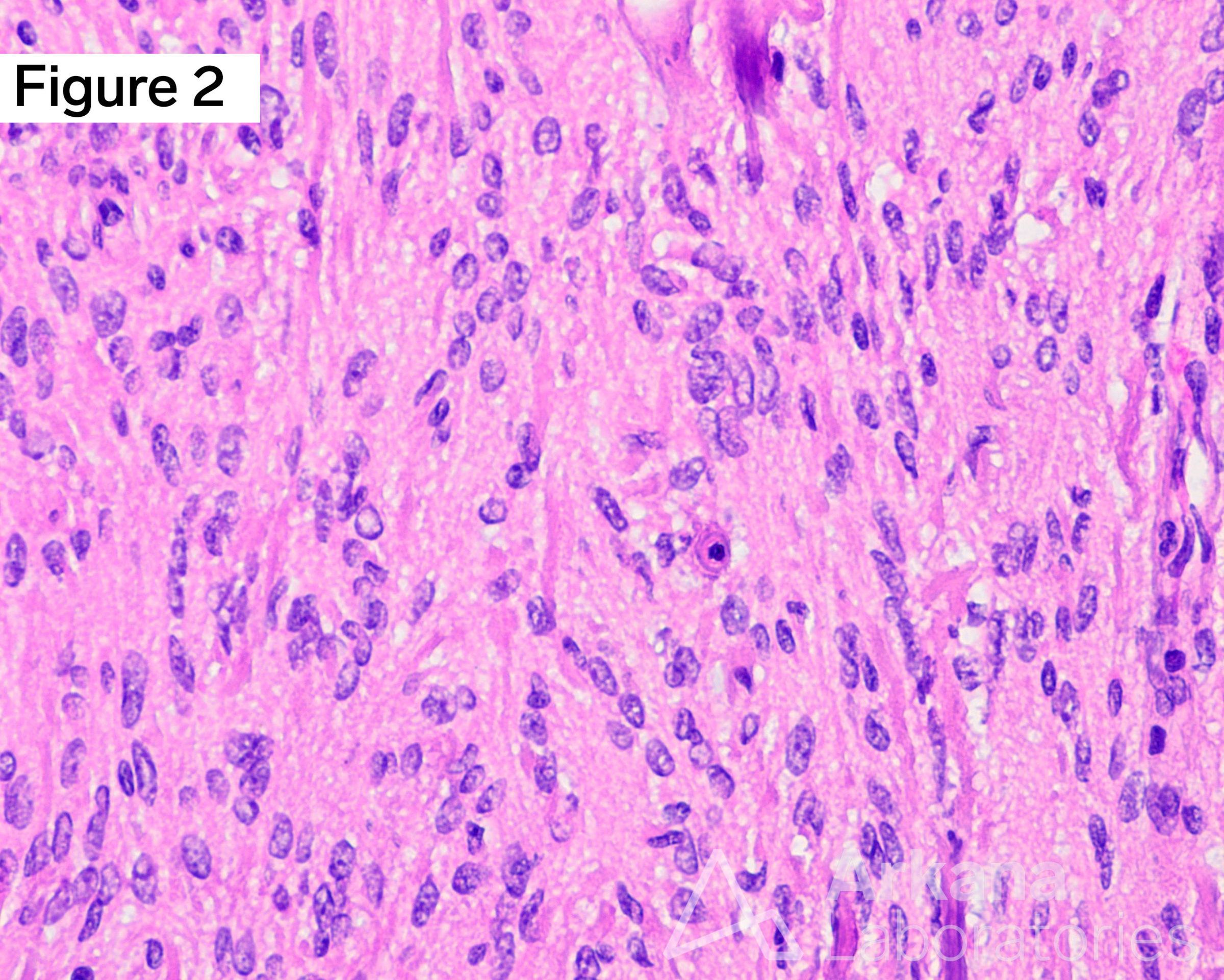 exceedingly rare mitotic figure, EMA+, SSTR2+, STAT6-