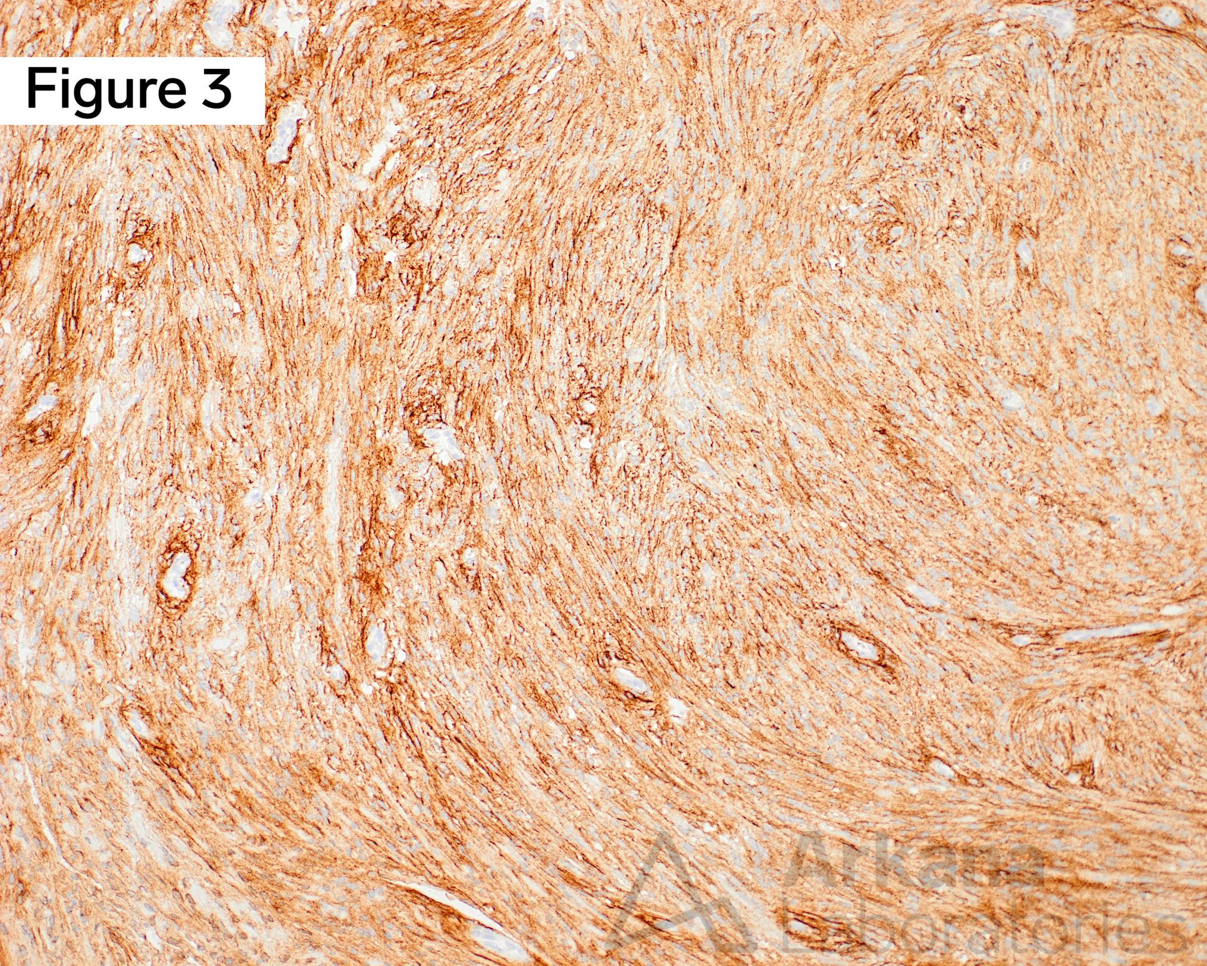 Immunohistochemical (IHC) work-up demonstrated strong diffuse membranous staining with epithelial membrane antigen (EMA+)