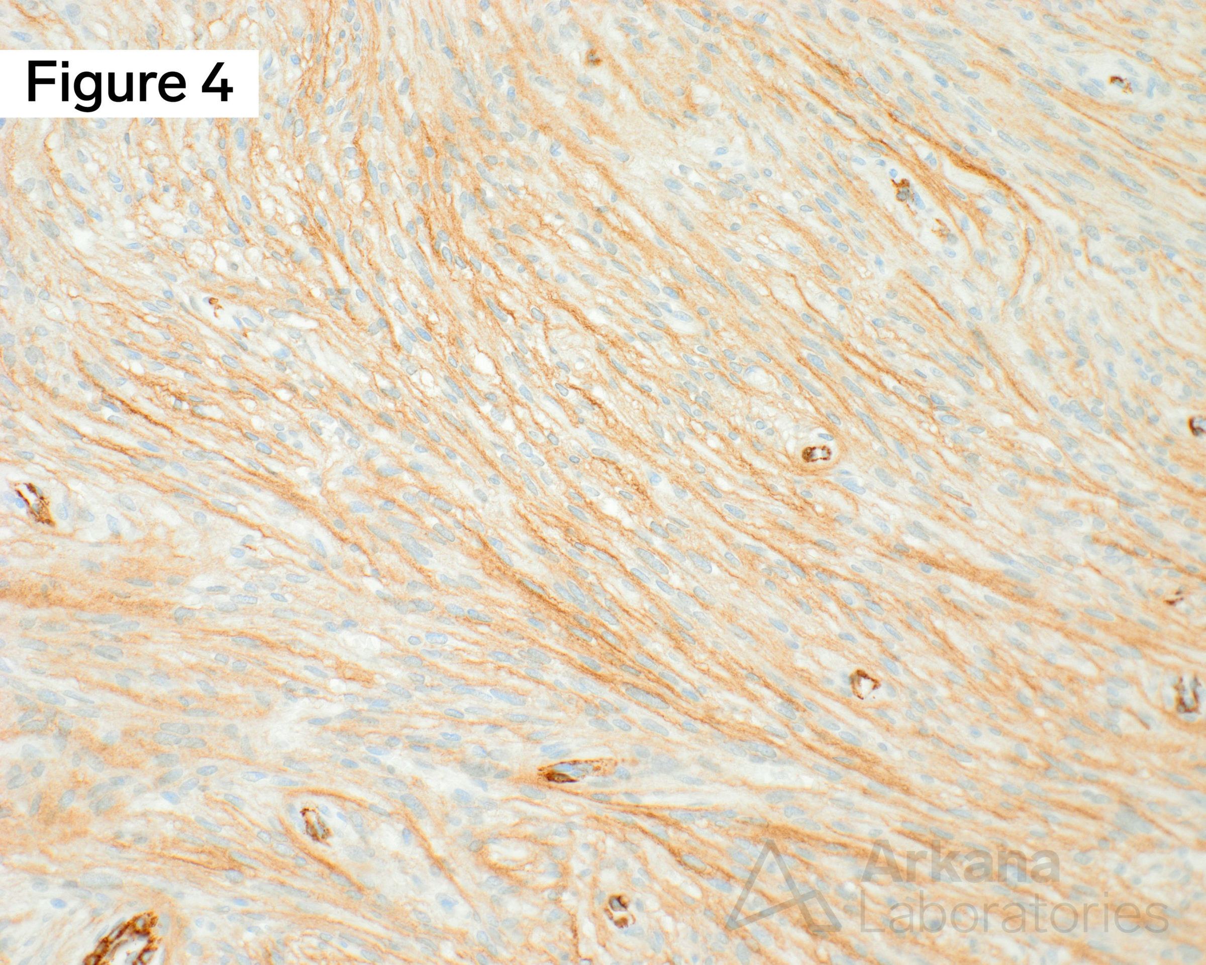 positive immunoreactivity for somatostatin receptor 2A (SSTR2+)