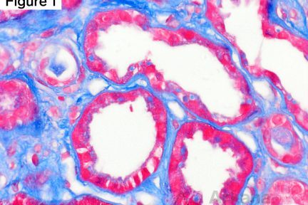 Amyloid Proximal Tubulopathy