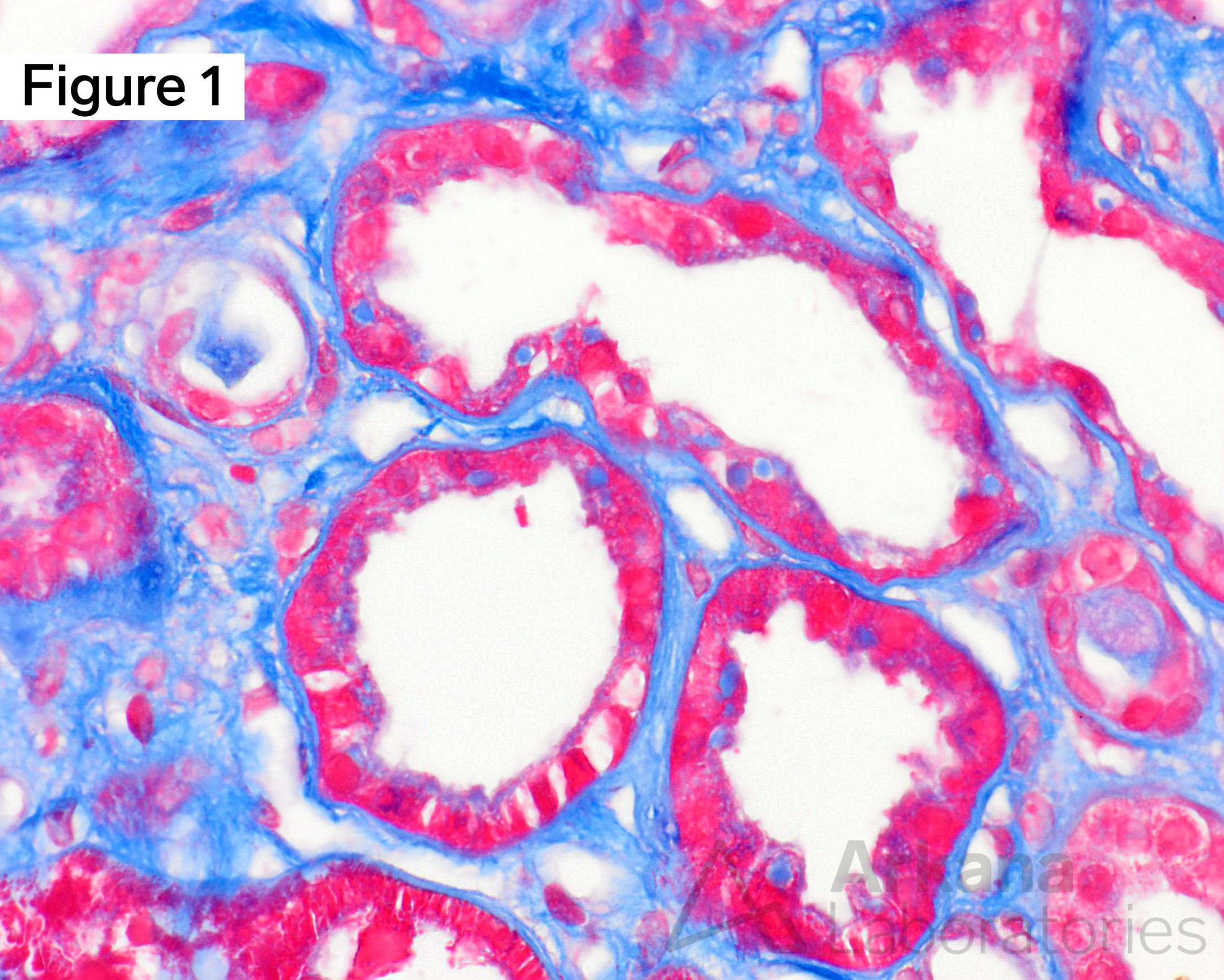 Amyloid Proximal Tubulopathy