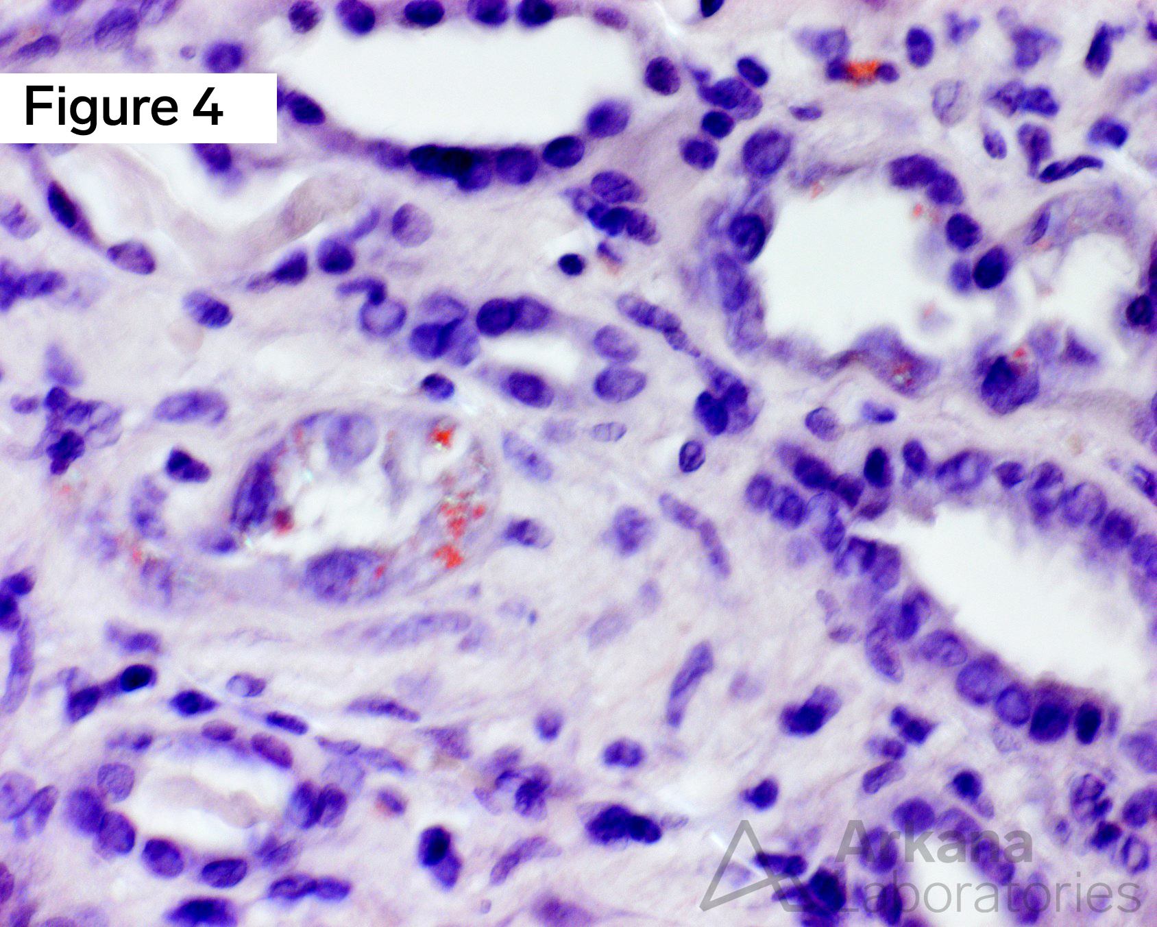 congophilic tubular epithelial inclusions polarized, Amyloid Proximal Tubulopathy