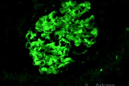 Fibrillary Glomerulopathy, Diagnose This!, Arkana Laboratories, pathology, nephropathology, renal pathology