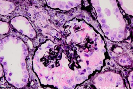 Tags: Collapsing GN, Nephrotic syndrome, APOL1, G1/G2, transplant, COVID-19, Diagnose This