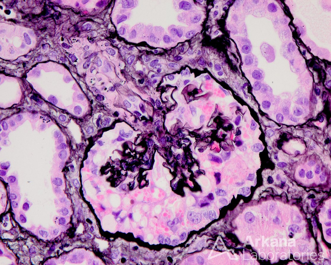 Tags: Collapsing GN, Nephrotic syndrome, APOL1, G1/G2, transplant, COVID-19, Diagnose This