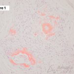 Hereditary Amyloid Neuropathy
