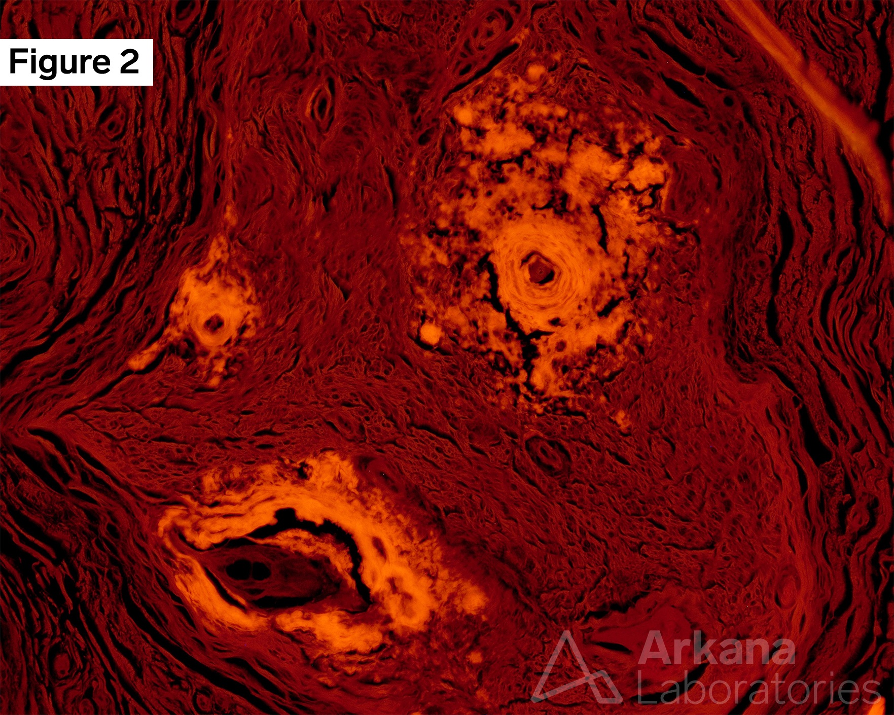 amyloid, TTR gene