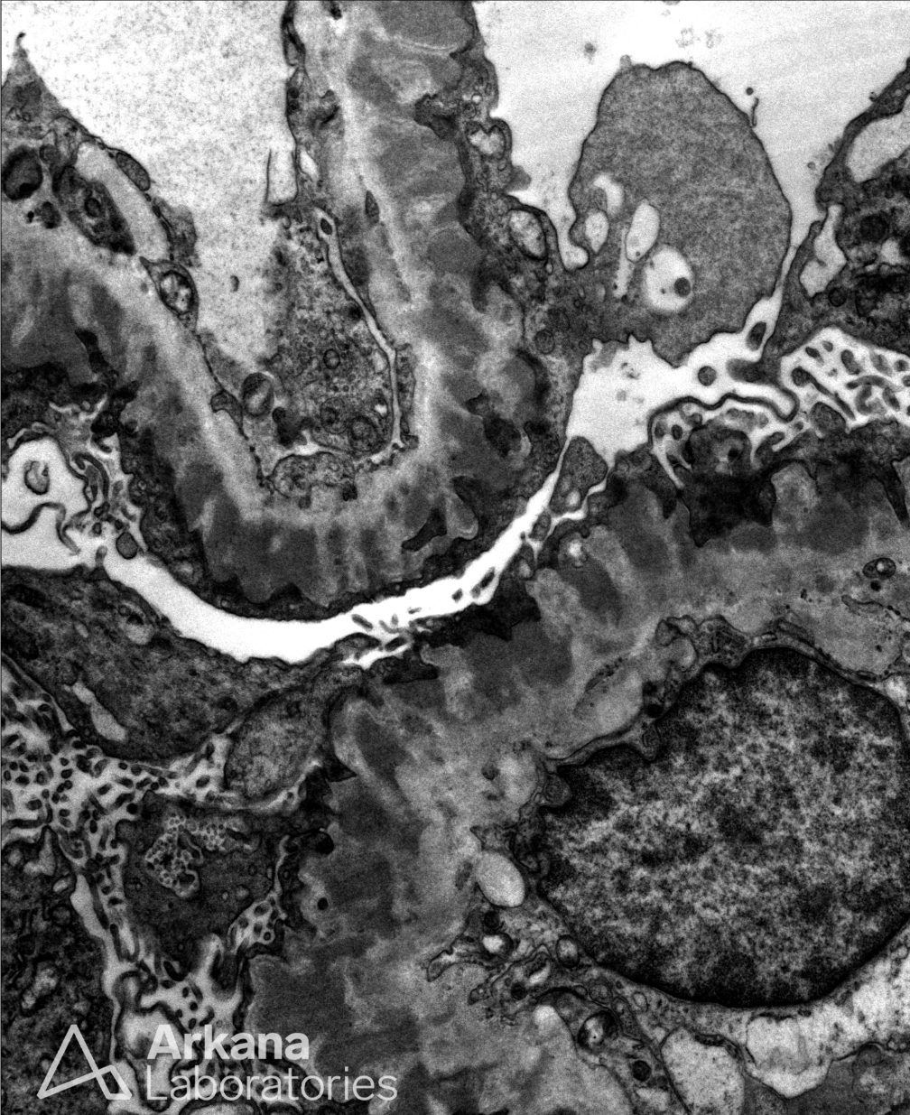 Membranous Glomerulopathy, PLA2R, Diagnose This, renal pathology, Arkana Laboratories