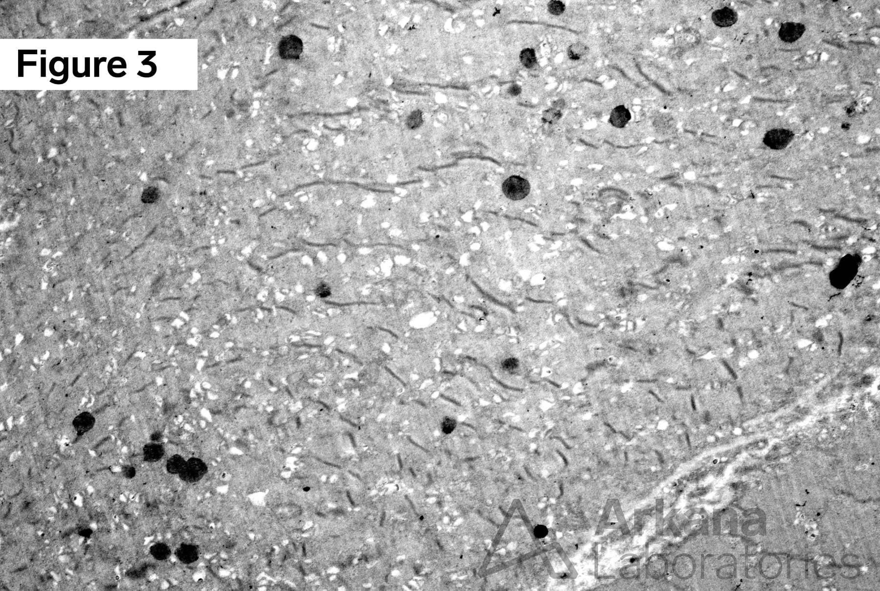 critical illness myopathy