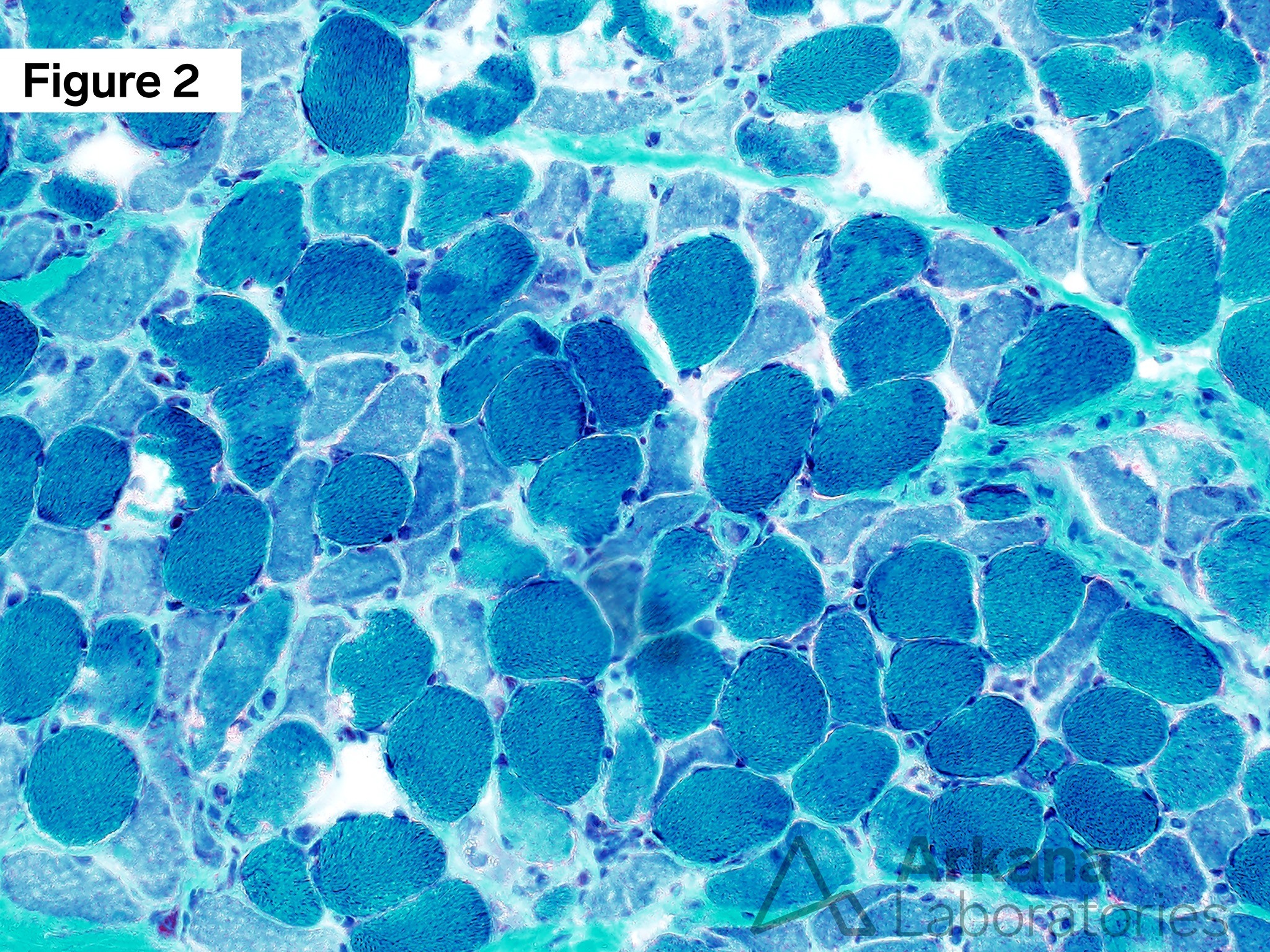 critical illness myopathy