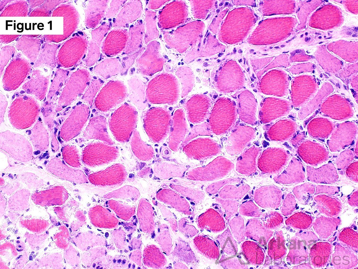 critical illness myopathy