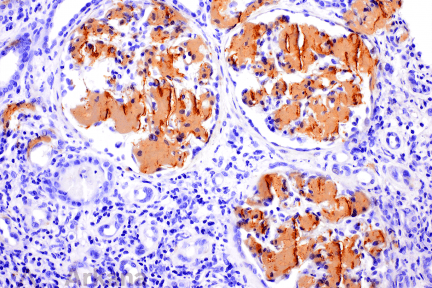 Amyloidosis, AA amyloid, IV drug, proteinuria