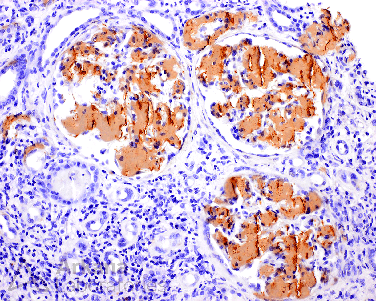 Amyloidosis, AA amyloid, IV drug, proteinuria