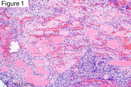 Tissue Gram stain, inflamed skeletal muscle