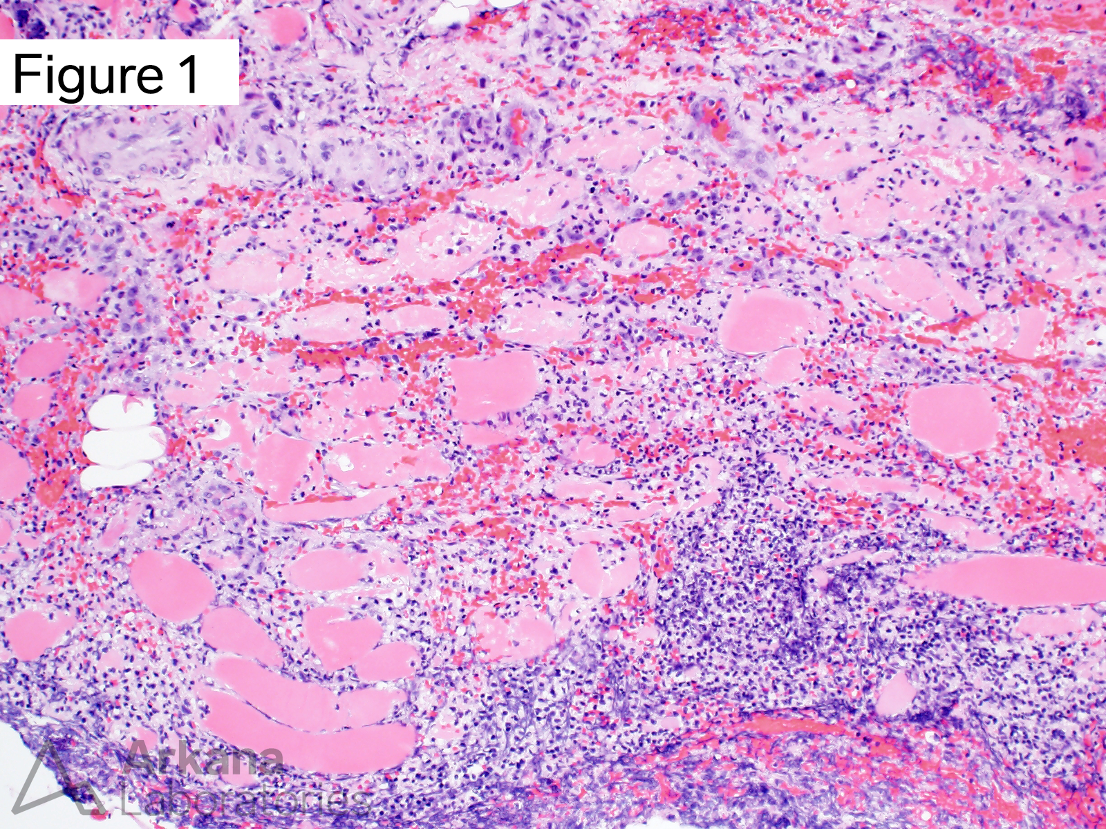 Tissue Gram stain, inflamed skeletal muscle