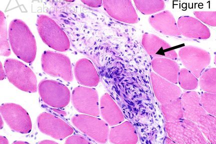 Neurofibromatosis type 1