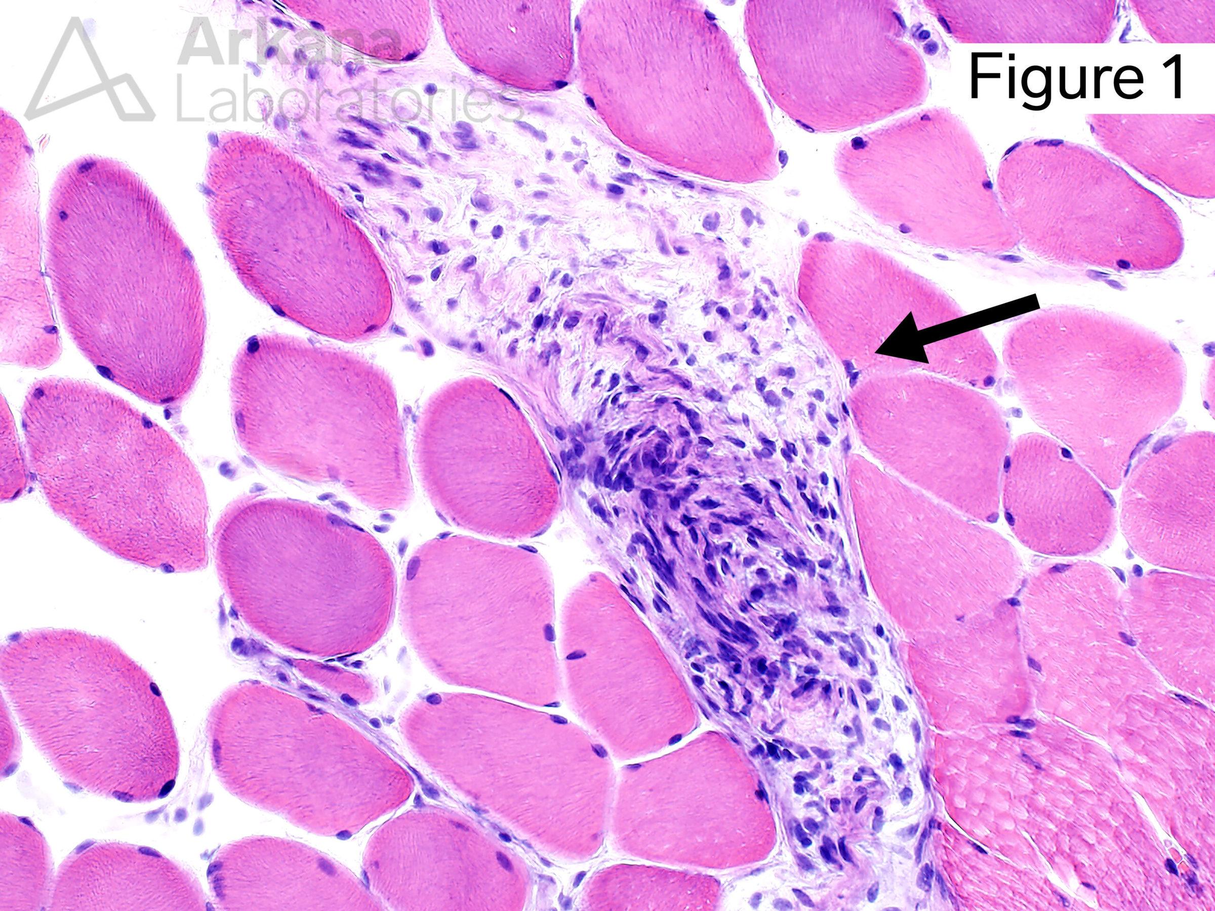 Neurofibromatosis type 1