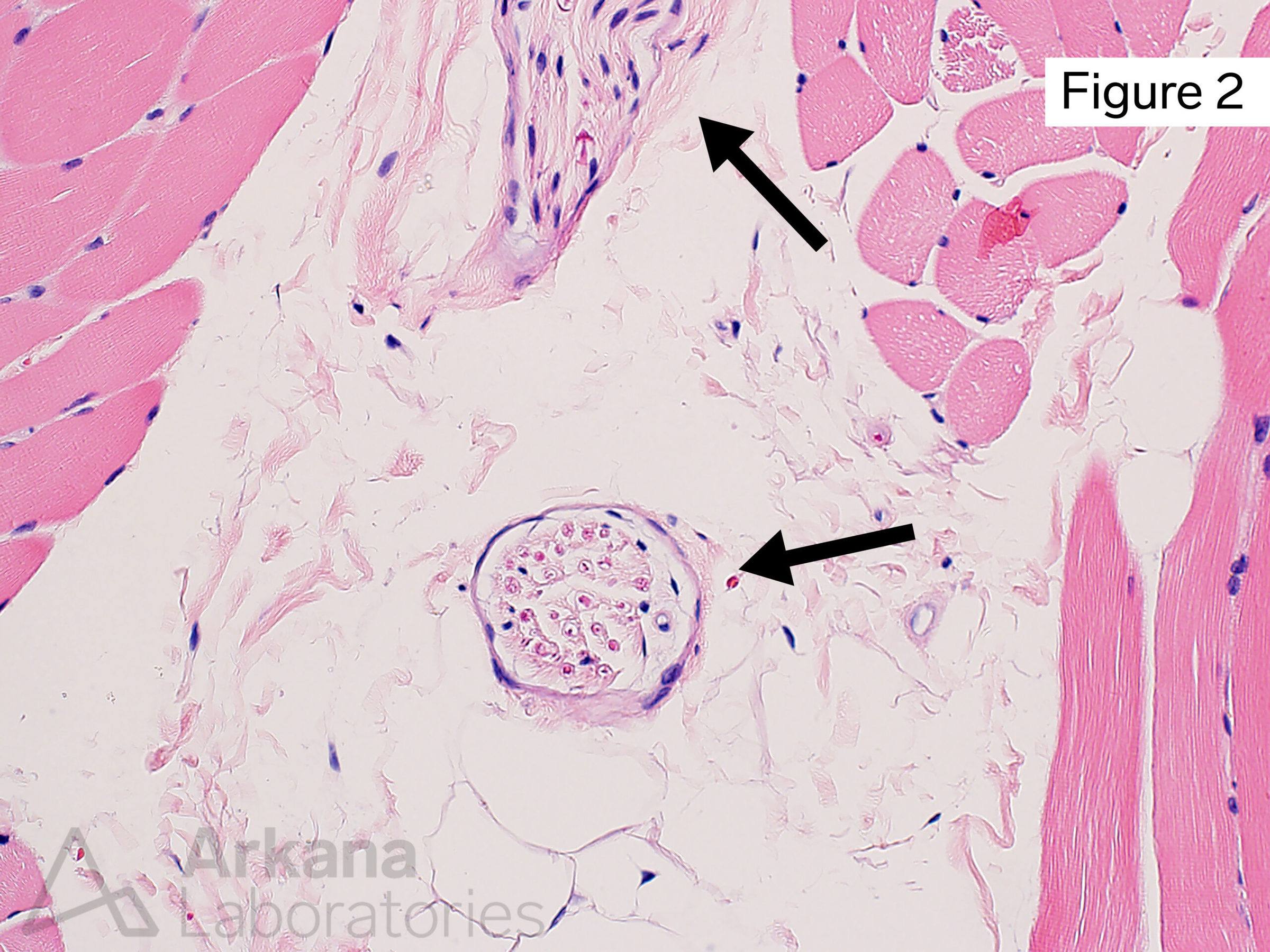 Neurofibromatosis type 1