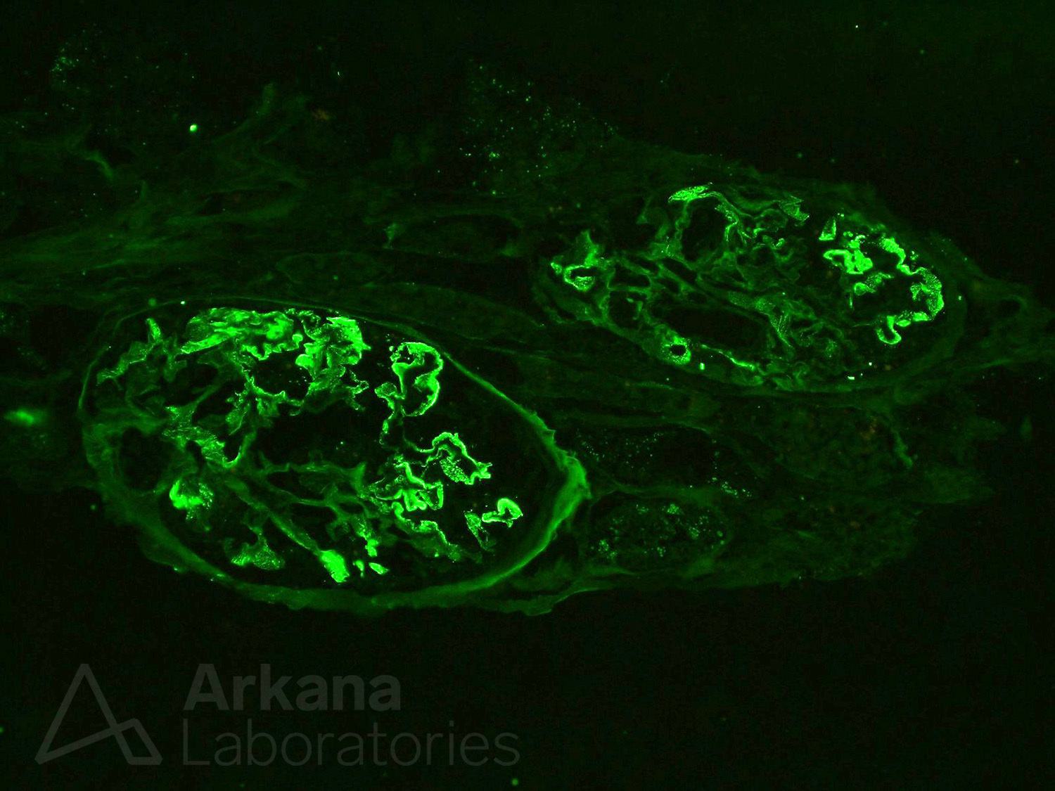 onco-nephrology, renal pathology, cancer in the kidney