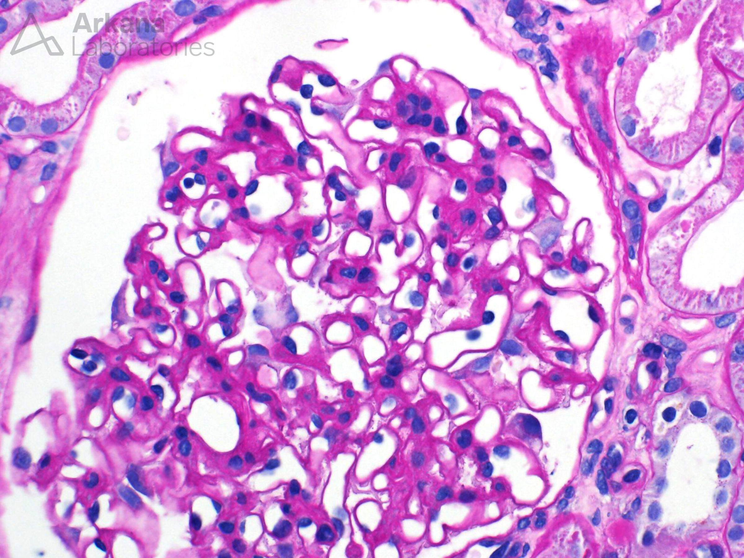 onco-nephrology, Mild mesangial sclerosis & hypercellularity